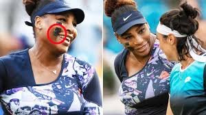 Serena Williams: What is on face| What has got on her face