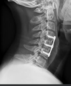 Chris Carson: Neck surgery| Neck xray| Neck brace