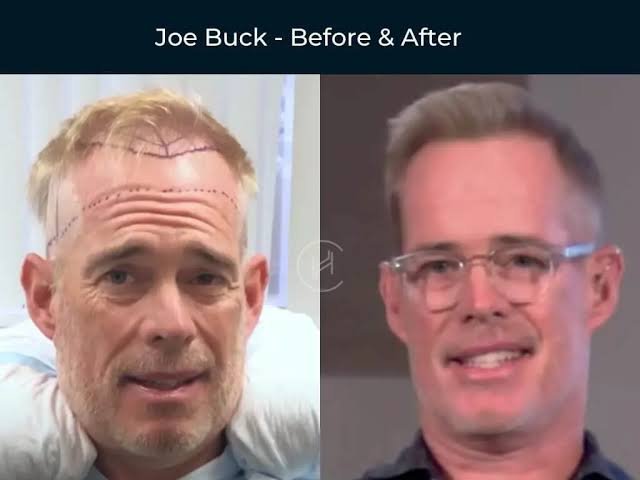 Joe Buck: Where did go to college| Did play sports| Hair transplant